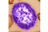 Pennsylvania reports 6th measles death